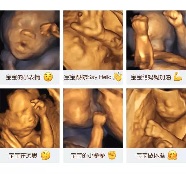 做超声影像（四维彩超）时，如何让胎宝宝配合检查？